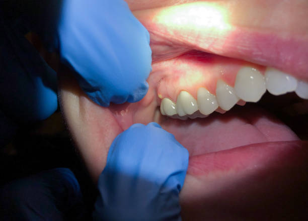 Best Dental Abscess Treatment in Greer, SC