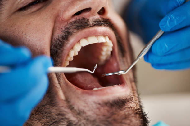 Best Emergency Wisdom Tooth Extraction in Greer, SC