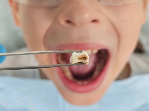 Best Emergency Treatment for Oral Infections in Greer, SC